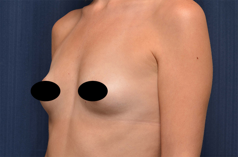 Breast Augmentation Before and After