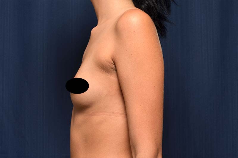 Breast Augmentation Before and After