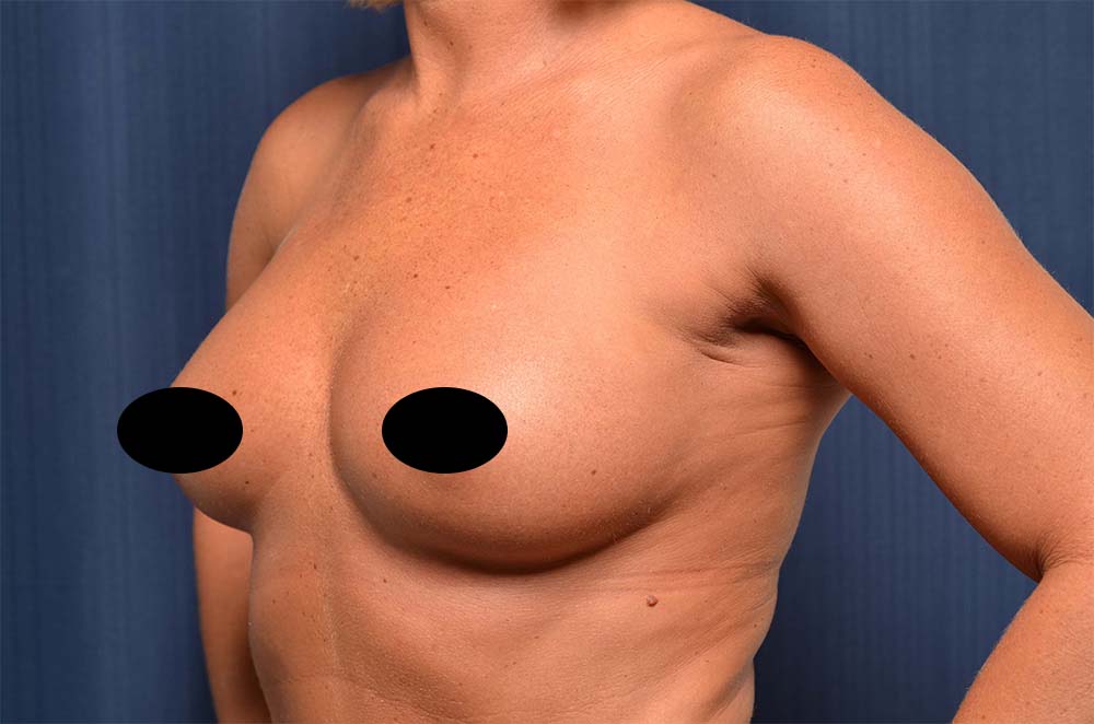 Breast Augmentation Before and After