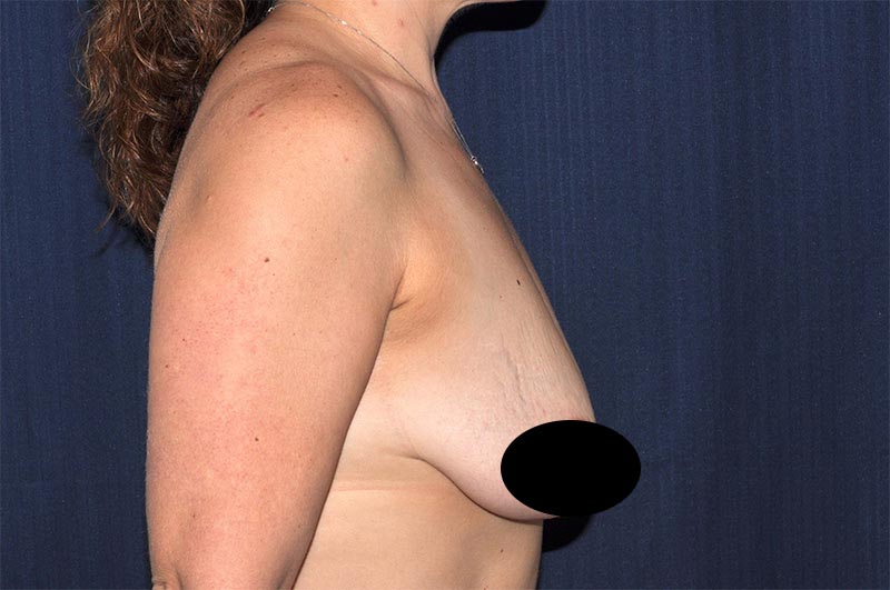 Breast Augmentation with Lift