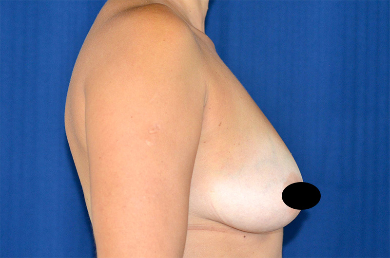 Breast Augmentation with Lift