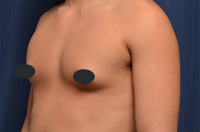 Gynecomastia