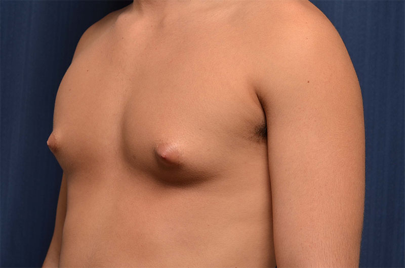 Gynecomastia