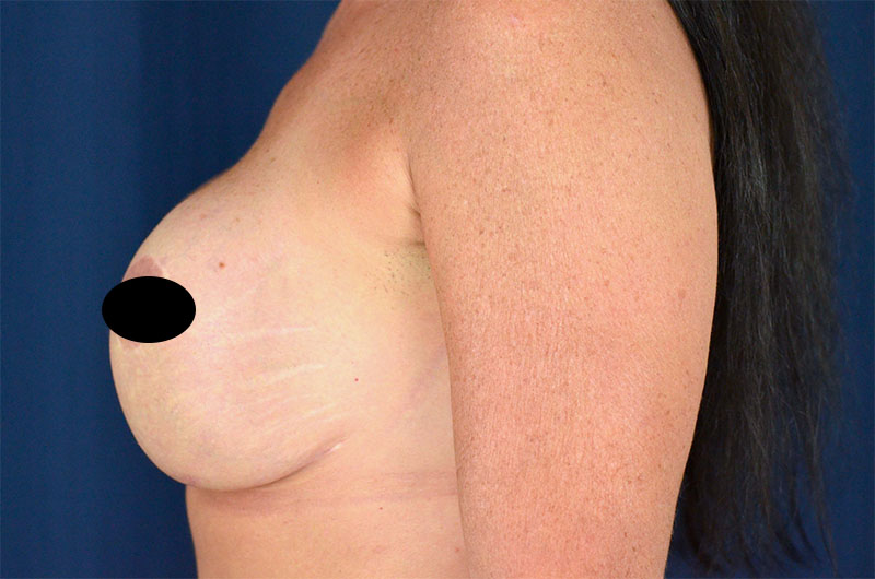 Breast Implant Revision