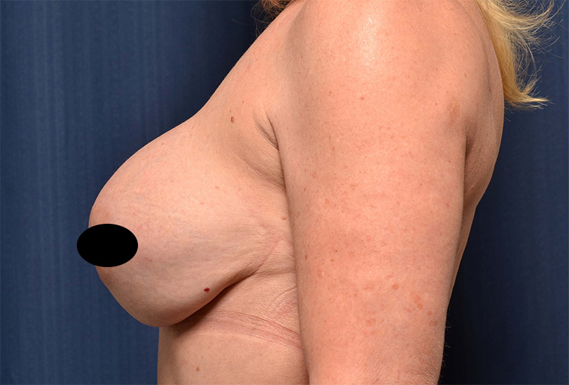 Breast Implant Revision