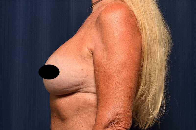 Breast Implant Revision