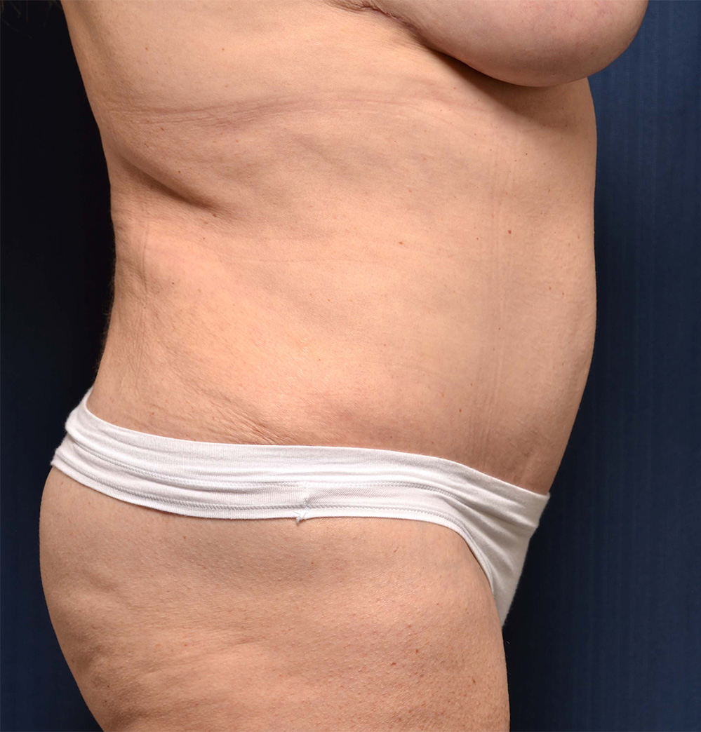 Tummy Tuck