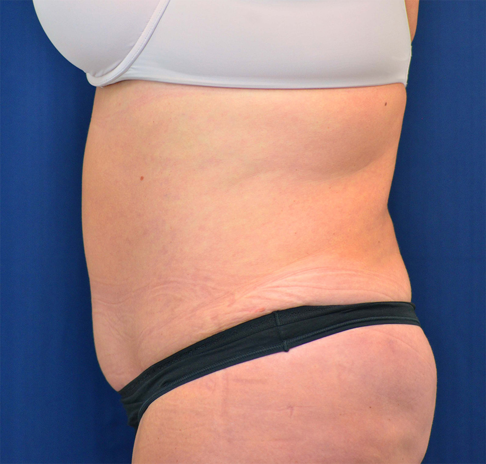 Tummy Tuck