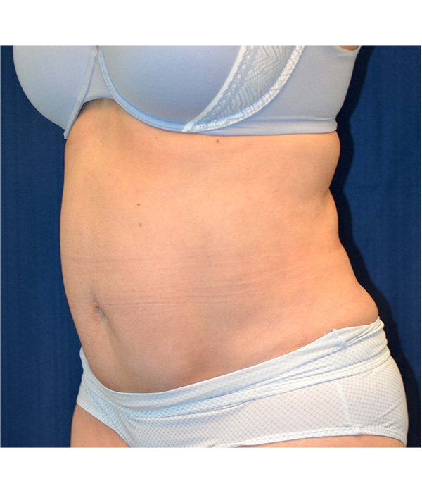 Tummy Tuck
