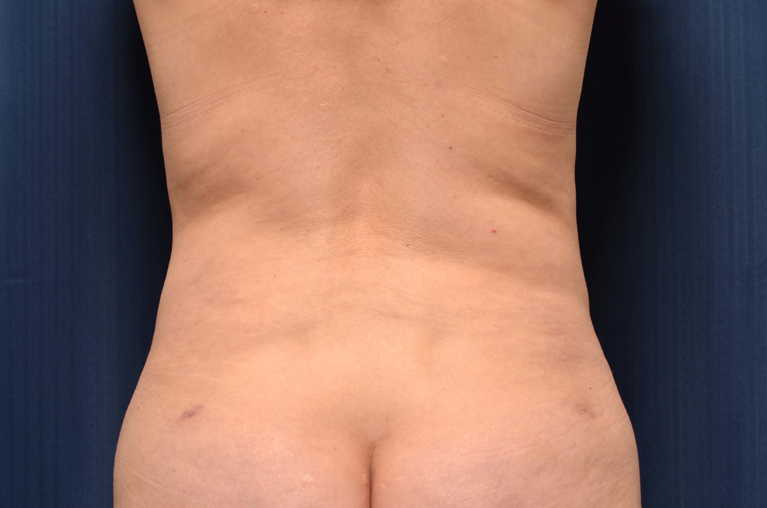 Liposuction