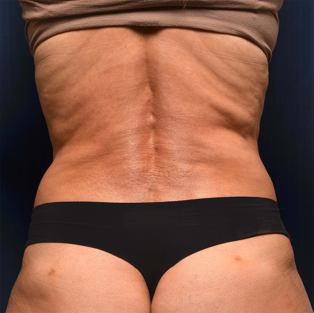 Tummy Tuck