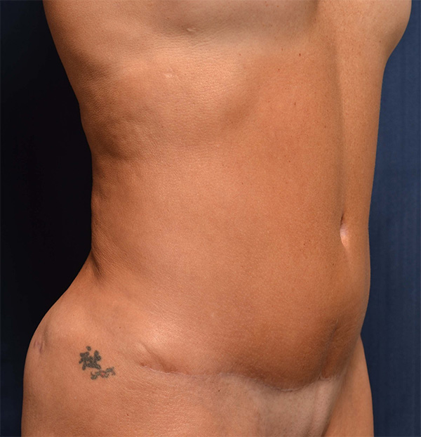 Tummy Tuck