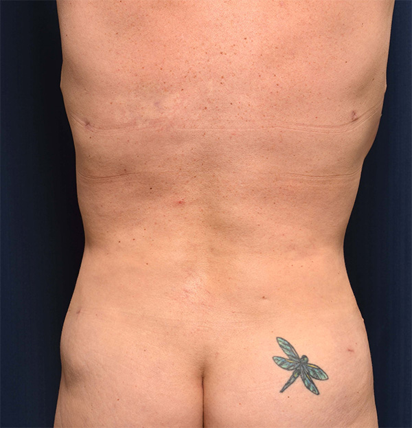 Tummy Tuck