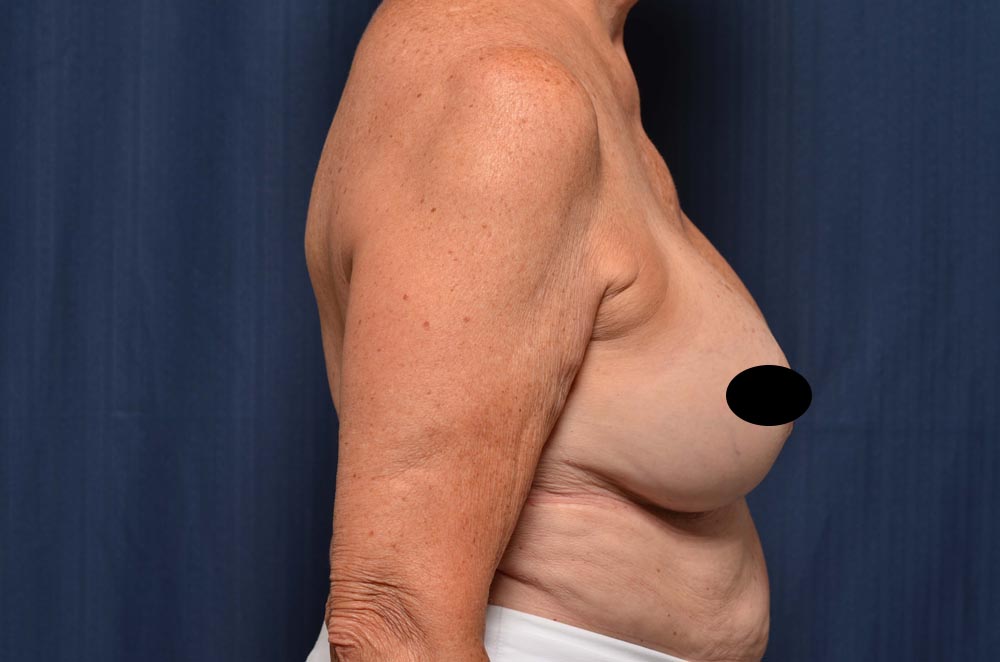 Breast Augmentation with Lift