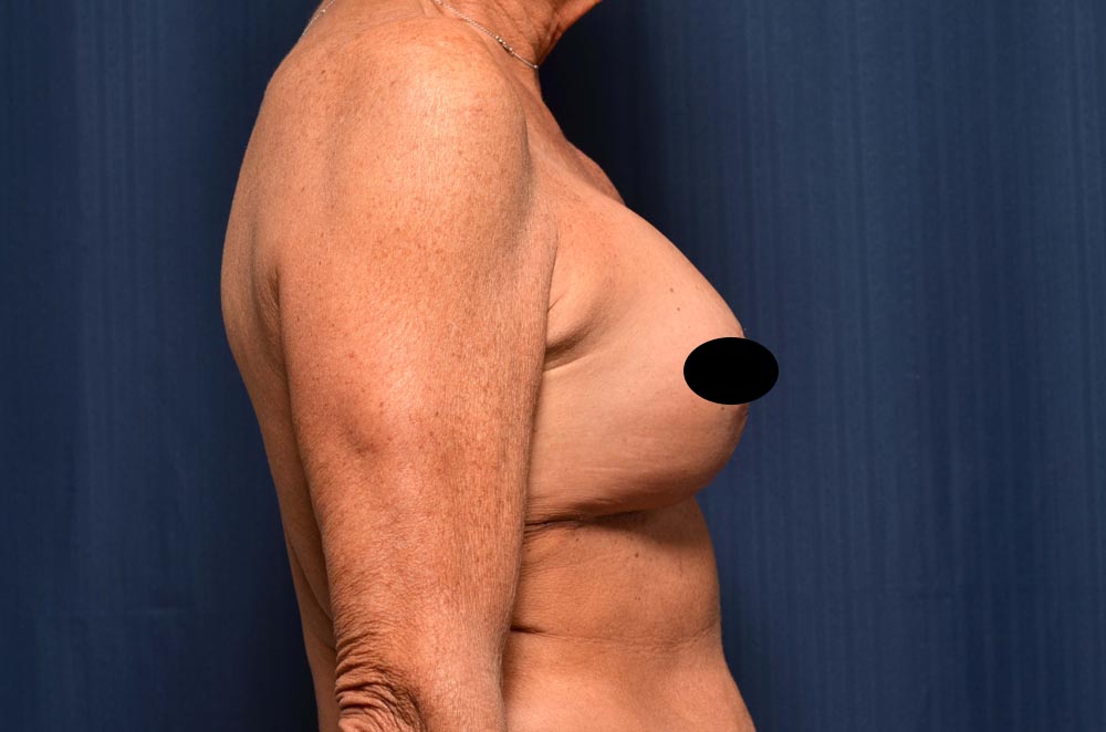 Breast Augmentation with Lift