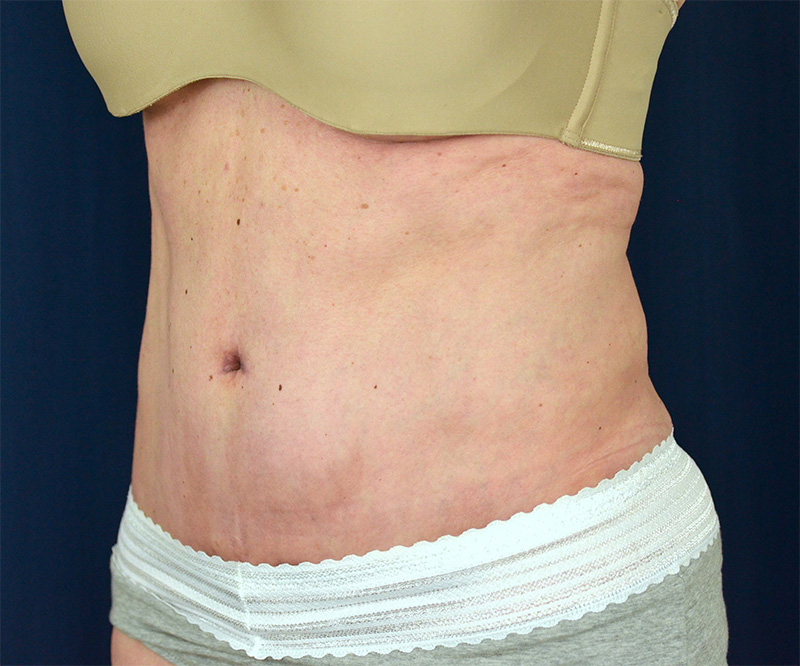 Tummy Tuck