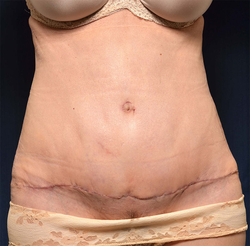 Tummy Tuck