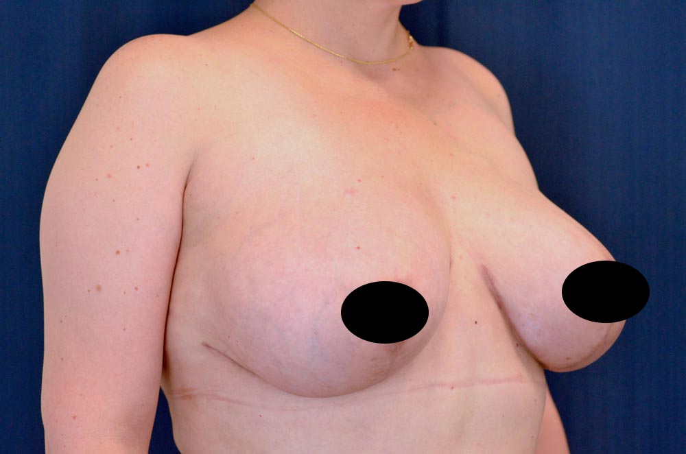 Breast Lift Reduction