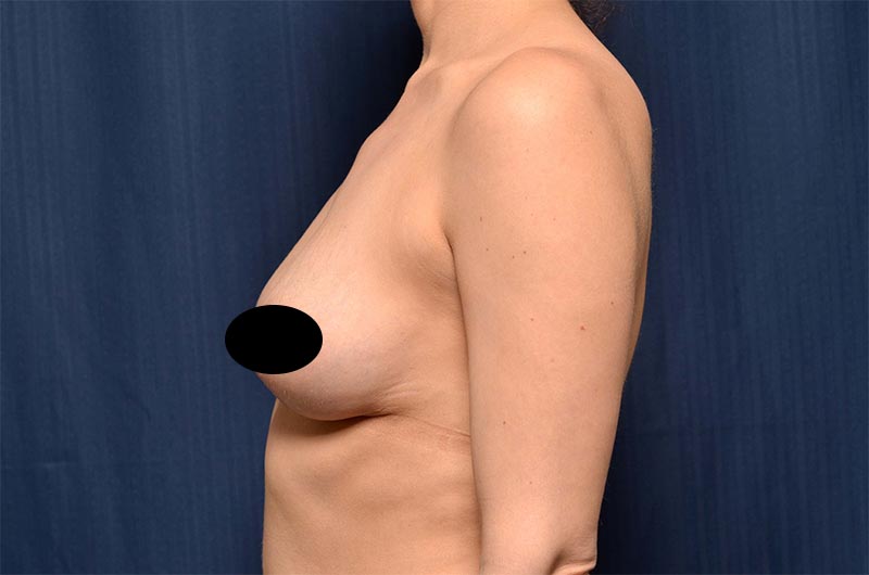 Breast Lift Reduction