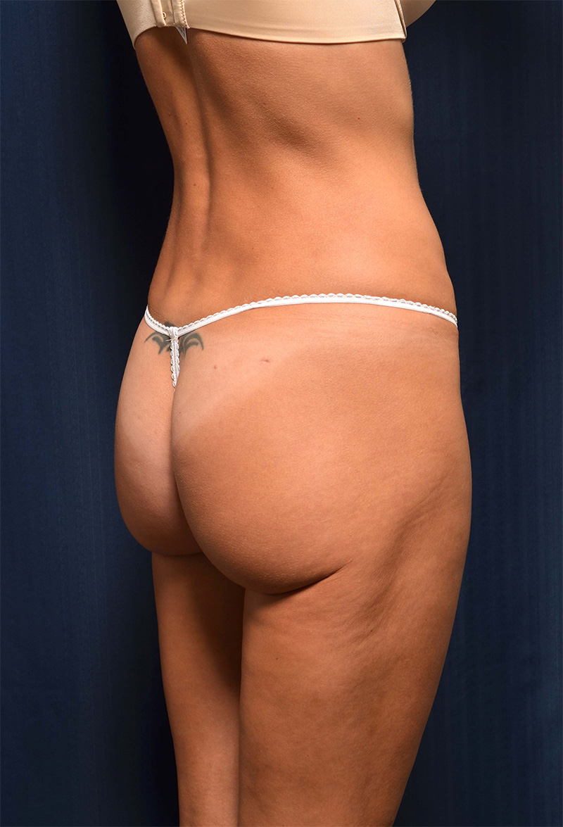 Brazilian Butt Lift Before & After