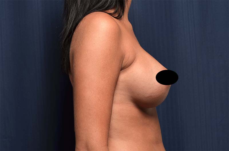 Breast Augmentation Before and After