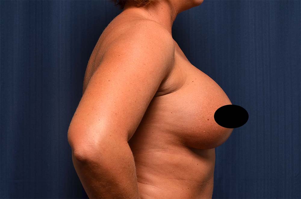 Breast Augmentation Before and After