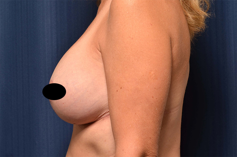 Breast Augmentation with Lift