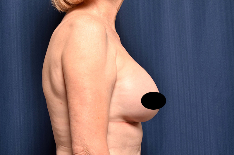 Breast Implant Revision