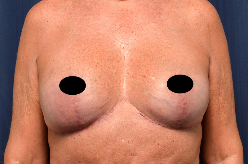 Breast Implant Revision