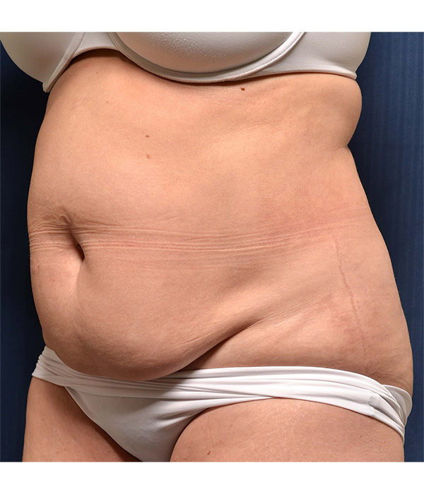 Tummy Tuck