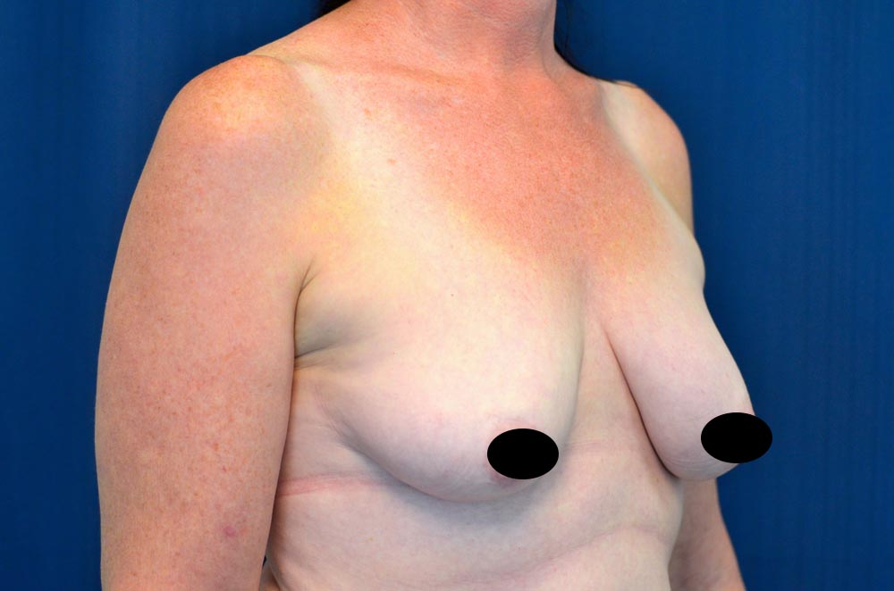 Breast Augmentation with Lift