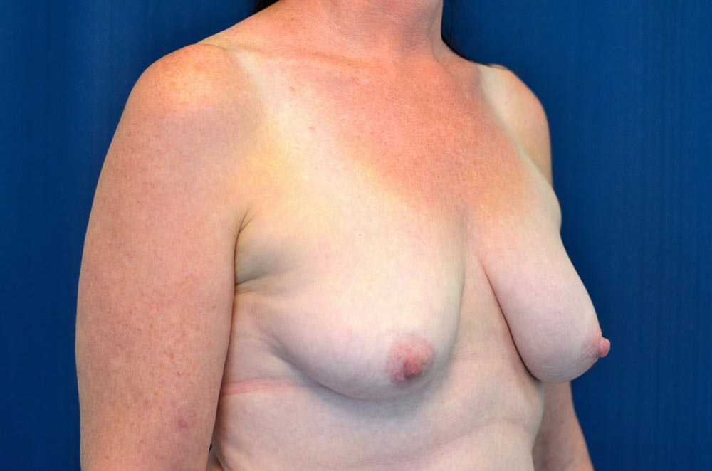 Breast Augmentation with Lift