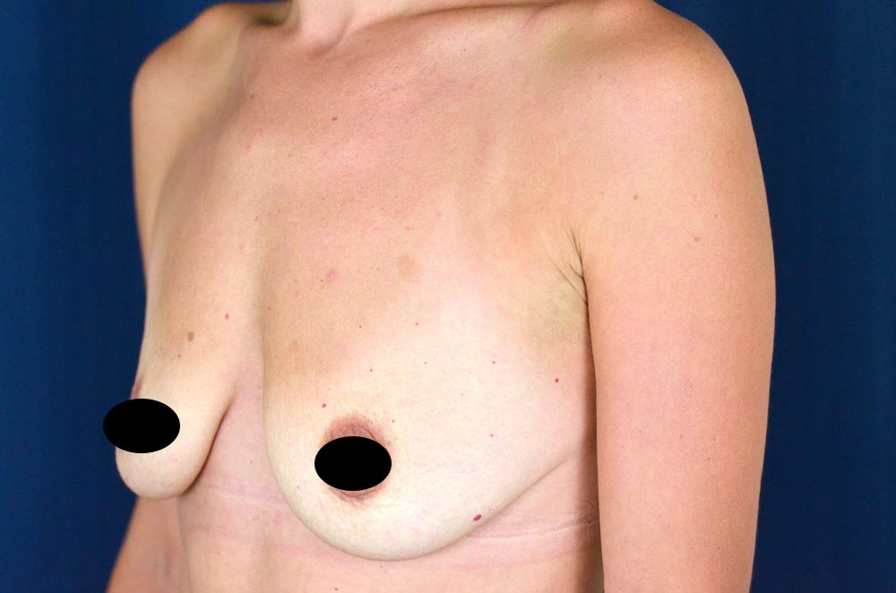 Breast Augmentation with Lift