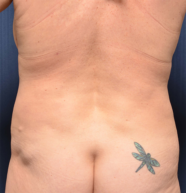 Tummy Tuck