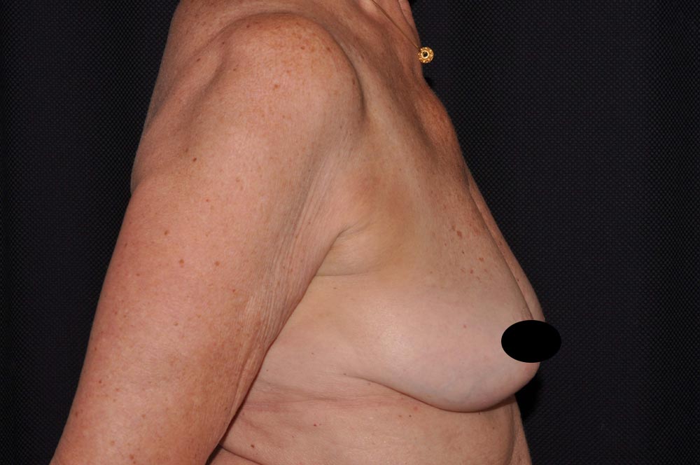 Breast Augmentation with Lift