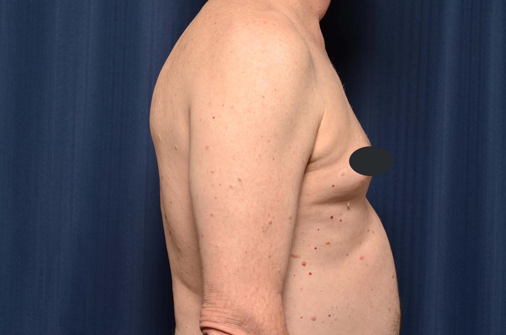 Gynecomastia