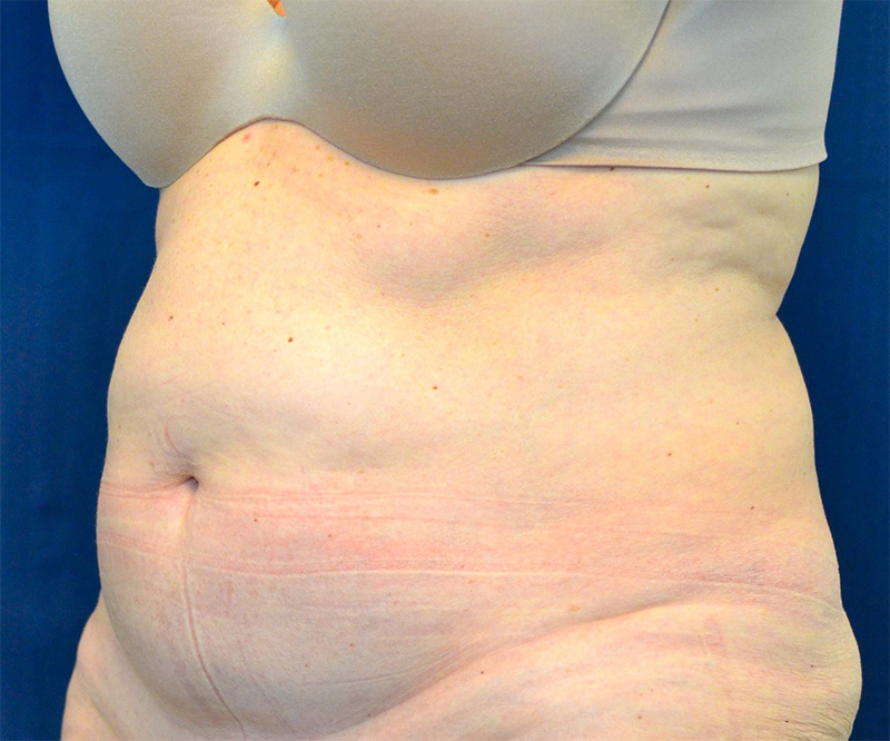 Tummy Tuck