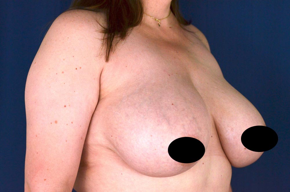 Breast Lift Reduction