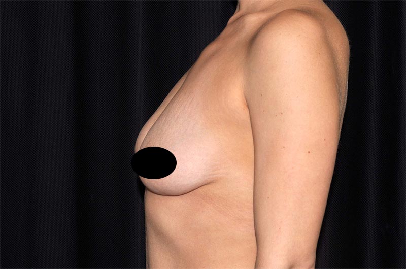 Breast Lift Reduction