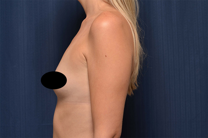 Breast Augmentation Before and After