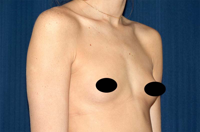 Breast Augmentation Before and After