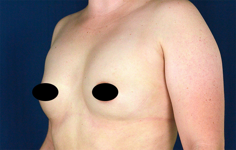 Breast Augmentation Before and After