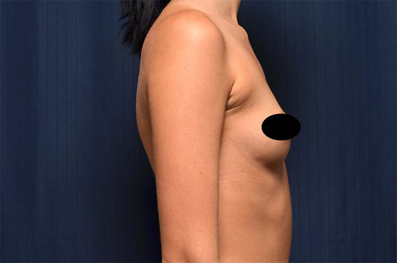 Breast Augmentation Before and After