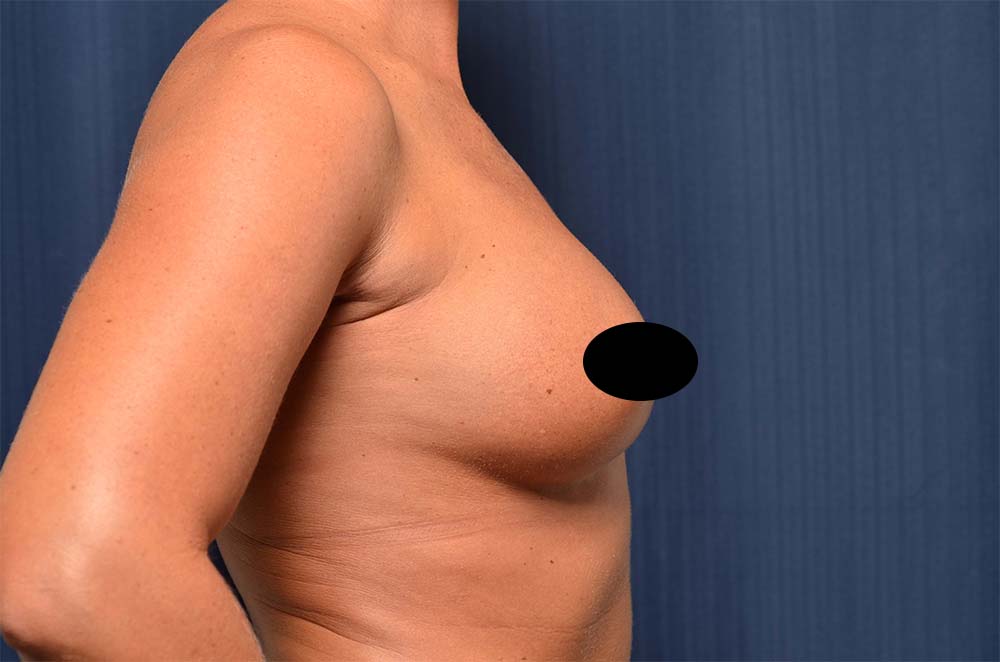 Breast Augmentation Before and After