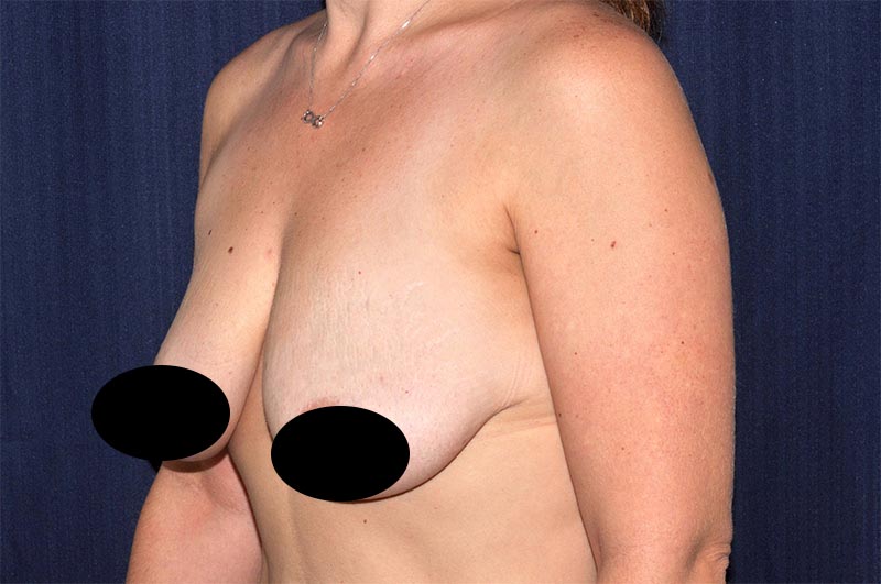 Breast Augmentation with Lift