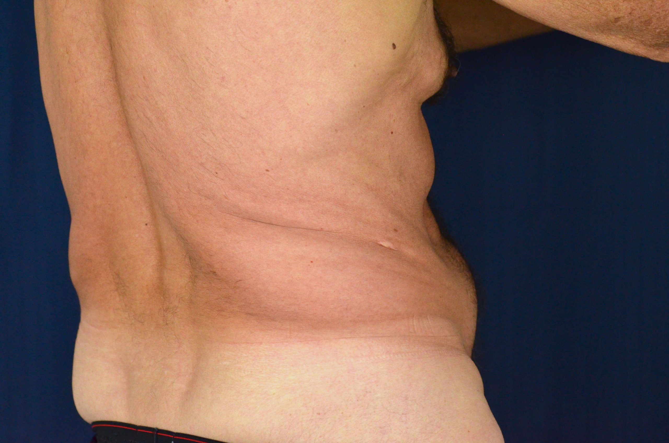 Tummy Tuck