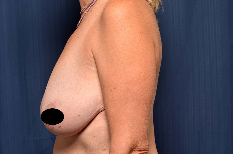 Breast Augmentation with Lift