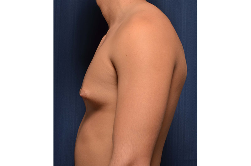 Gynecomastia