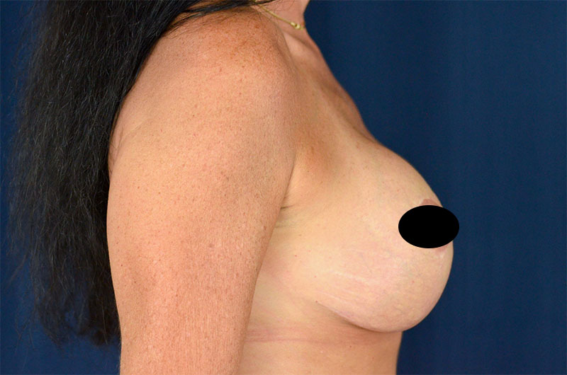 Breast Implant Revision
