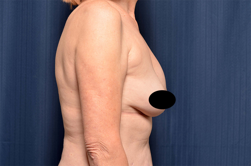 Breast Implant Revision